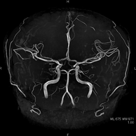 ＭＲＡ画像（血管像）