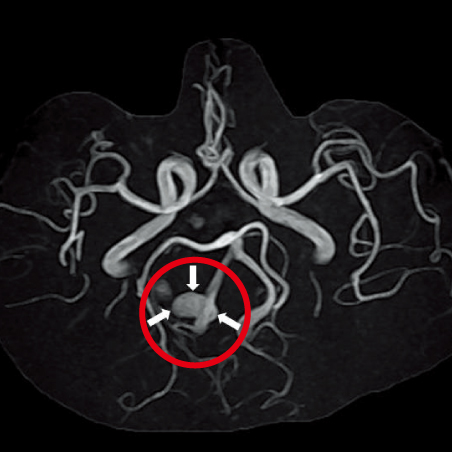 脳動脈瘤