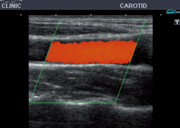 頸動脈超音波