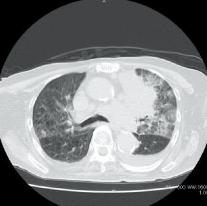 肺がん（異常像）